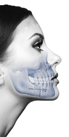 Maxillofacial Surgery Wallpaper, Orthognathic Surgery, Homemade Mouthwash, Maxillofacial Surgery, Facial Bones, Jaw Surgery, Facial Surgery, Facial Nerve