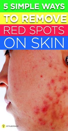 11 Home Remedies For Scleroderma And Prevention Tips Spots On Skin, Brown Age Spots, Brown Spots On Skin, Brown Spots Removal, Brown Spots On Face, Skin Spots, Spots On Face