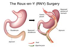 Dumping Syndrome, Gastric Band, Bariatric Surgeon, Sleeve Gastrectomy, Digestive Juice, Bypass Surgery, Best Hospitals, Gastric Bypass