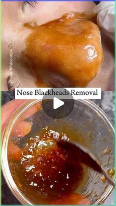 Baking Soda And Apple Cider Vinegar Face Mask, Best Mask For Blackheads, Diy Facemask Skincare Blackheads, Face Mask That Pulls Out Blackheads, How To Make Face Mask For Blackheads, Blackheads Mask Diy, Diy White Head Remover, Getting Rid Of Blackheads On Nose, Face Pack For Blackheads