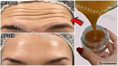 #wrinklesonforhead #wrinklesundereyes #wrinklesremoval #wrinkles Face Wrinkles Anti Aging, Healthy Eating Quotes, Throbbing Headache, Top Anti Aging Products, Neck Wrinkles, Ageless Beauty, Health Skin Care