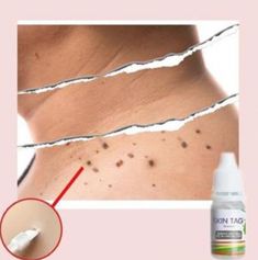 Facial Warts, Remove Skin Tags Naturally, Tag Remover, Natural Hair Mask, Skin Tags, Easy Face Mask Diy, Boost Hair Growth, Gorgeous Skin, Beauty Advice