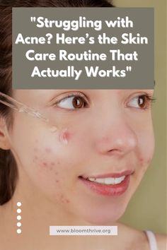 Say goodbye to breakouts with this targeted skin care routine. Tailored for acne-prone skin, it focuses on deep cleansing, healing, and preventing new blemishes. #ClearSkinJourney #AcneFree #SkinCareRoutine Acne Free, Deep Cleansing