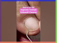 The correct technique when using the ingrown toenail sidewall cleaner. You can purchase this tool here: https://www.meticulousmanicurist.com/shop/p/ingrown-t... Regrow Hair Naturally, Ingrown Toenail, Natural Healing Remedies, Medical Terminology, Brittle Nails, Ingrown Toe Nail, Prom Hairstyles For Long Hair