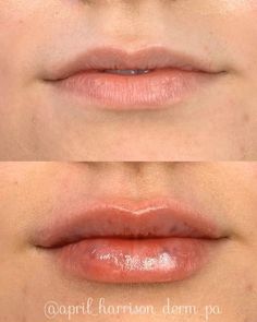 Lip Fillers Before And After 1ml, Facial Care Routine, Esthetician Inspiration, Injectables Fillers