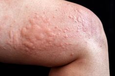 Hives Remedies, Chronic Hives, Types Of Acne, Autoimmune Disorder, Skin Diseases, Itchy Skin, Prenatal, Dermatology, Skin Problems