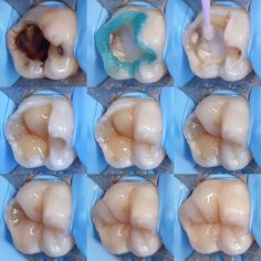 Composite filling - step by step Dental Hygiene Student, Dental World, Dental Hygiene School, Dental Fun, Dental Fillings