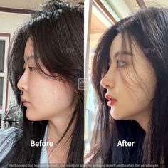 Our Korean patient wanted a change her nose shape, so she came to VIEW Plastic Surgery for her rhinoplasty. #koreanplasticsurgery #plasticsurgery #plasticsurgerykorea #cosmeticsurgery #seoul #korea #rhinoplasty #nosesurgery #nosejob #asianrhinoplasty #asiannosejob #rhinoplastysurgeon #barbierhinoplasty #viewplasticsurgery Lip Plastic Surgery, Plastic Surgery Fails, Nose Plastic Surgery, Nose Surgery Rhinoplasty