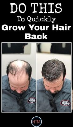 Ayurveda Hair Care, Bald Hair Growth, Mens Hair Regrowth, Ayurveda Hair, Hair Growth Women, Hair Growth For Men, Female Pattern Baldness, Hair Mask For Growth