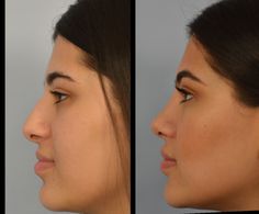 Closed Rhinoplasty, Ethnic Rhinoplasty, Face Surgery