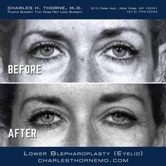 Dr. Thorne's lower (blepharoplasty) eyelid surgery technique https://charlesthornemd.com/face-surgery/blepharoplasty-eyelid-surgery.html - - #cosmeticsurgery #plasticsurgery #facelift #beforeandafter #plasticsurgeon #beauty #nyc #bestplasticsurgeon #newyork #facelift #surgery #beauty #chinimplant #transformation #beforeandafter #bestplasticsurgeon #blepharoplasty #doctor #necklift #boardcertifiedplasticsurgeon #eyes #eyelidsurgery Study Style