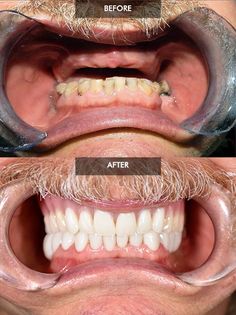 Home Remedies For Cavities, Dental Advertising, Dentist Art, Teeth Whitening Methods, Teeth Whitening Procedure, Dental Posters, Dental Work