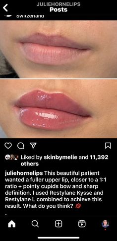 Natural Lip Injections Before And After, Lip Filler Inspiration Small Lips, Types Of Lip Filler Shapes, Lip Filler On Full Lips, At Home Lip Filler, 1ml Lip Filler Shapes, Needless Lip Filler, Keyhole Lip Fillers, Different Lip Shapes