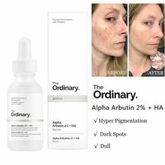 The Ordinary Alpha Arbutin, Best Acne Products, The Ordinary Skincare, Acne Oil, Whitening Face, Alpha Arbutin, Uneven Skin Tone, Skin Care Regimen