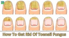 Toenail Fungus Essential Oils, Nail Remedies, Fingernail Fungus, Toenail Fungus Remedies, Nail Fungus Remedy, Nail Infection, Fungal Nail, Toenail Fungus, Fungal Infection