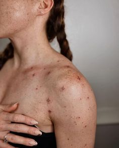 a woman with acne on her chest