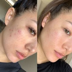 January 292020 to February 292020just 4 weeksAlright guysthis is embarrassing but I have oilyacne proneaging skin with some fine lines and skin discoloration from the sun and acne.… Cinnamon Face Mask, Night Skin Care Routine, Get Rid Of Blackheads, Cleansing Face, Skin Pores, January 29, Skin Discoloration, How To Treat Acne