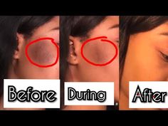 How To Get Rid Of Black Private Part, How To Remove Sunburn On Face, How To Treat Sunburn On Face, How To Get Rid Of A Sunburn Fast, Sunburn Remedies For Face, Home Remedy For Sunburn, How To Remove Sunburn, Sunburn On Face, Turmeric Teeth Whitening