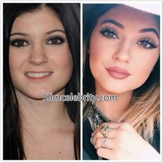 kendall jenner before and after | Kylie Jenner Plastic Surgery Before and After Photos: Nose Job, Lip ... Kylie Jenner Plastic Surgery, Kylie Kardashian, Lip Enhancement, Lip Injections, Lip Fillers