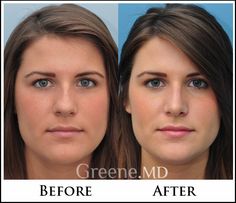 Bulbous Nose Rhinoplasty Before After, Bulbous Nose Rhinoplasty, Nose Operation, Nose Jobs