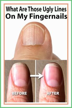 Nail Symptoms, Nail Problems, Nail Vitamins, Tongue Health