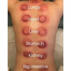 Cupping Points, Wet Cupping, Massage Art, Benefits Of Cupping, Cupping Massage