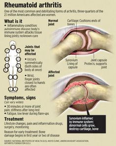 Rheumatoid Arthritis- chronic inflammatory disorder with an insidiuous onselt. Usually arises between the ages of 30 and 50. Autoimmune Disorder, Pose Yoga, Autoimmune Disease, Chronic Pain, Ayurveda, Reiki, Surgery, Disease, Massage