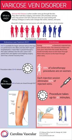 Varicose Vein Treatment Infographic Home Remedies For Spiders, Vein Health, Varicose Vein Remedy, Venous Insufficiency, Medical Facts, Medical School Essentials, Fat Burning, Home Remedies, Cider