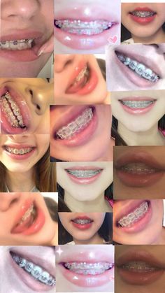 Braces Transformation, Braces Food, Clear Braces