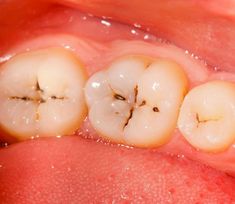 Tooth Caries, Dental Photos, Dental Cavities, Dental Office, Tooth Decay, Healthy Teeth, Dental Clinic, Cavities