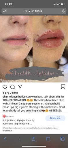 an image of someones lips before and after using lip fillers on their lips