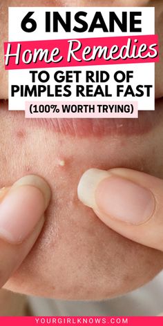 Rid Of Pimples Overnight, Get Rid Of Pimples Overnight, Get Rid Of Pimples, Rid Of Pimples