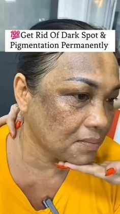 How To Get Rid Of Age Spots, Potato Face Mask Dark Spots, Pigmentation On Face, Pigmentation Remedy, Face Recipes, Egg Face Mask, Dark Circles Around Eyes, Face Cleaner, Turmeric Mask