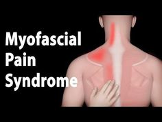 Myofascial Pain Syndrome, Referred Pain, Trigger Point Therapy, Neck Exercises, Myofascial Release, Trigger Point, Neck Pain Relief, Neck And Shoulder Pain, Trigger Points