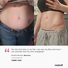 5 Types Of Tummies And The Ways In Which You Can Get Rid Of Each Of Them Surgery Day Outfit, Tummy Tucks Before And After, Tummy Tucks Recovery, Beauty Without Makeup, Mummy Tummy, Diastasis Recti Exercises, Mommy Makeover, Breast Reduction, Diastasis Recti