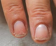 Nail Remedies, Nails After Acrylics, Cracked Nails, Peeling Nails, Weak Nails, Nail Repair