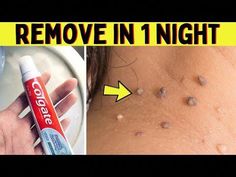 Apply this remedy overnight and remove tags from your neck, face or even eyelids. This is the world's best home remedy that I have found for the treatment of... Natural Remedies For Skin Tags, Remove Moles And Skin Tags, Diy Removal Of Skin Tags, Home Remedy For Skin Tags, Warts Removal On Face, Diy Remove Skin Tags At Home, Best Way To Remove Skin Tags, Skin Mole Removal At Home, Get Rid Of Skin Tags Fast