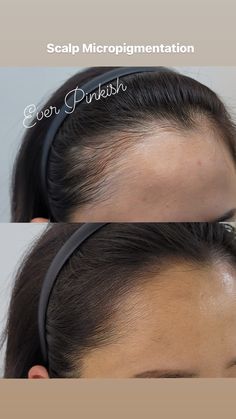 Traction Alopecia Regrowth, Hair Solution, Hair Transplant Cost, Androgenetic Alopecia, Thinning Hair