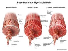 Muscular Anatomy, Fascia Blasting, Muscle Tear, Crps Awareness, Mobile Massage, Muscle Stretches, Muscle Knots, Vet Medicine, Basic Anatomy And Physiology