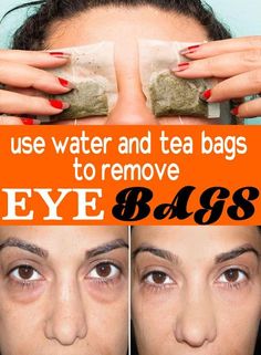 How To Get Rid Of Bags Under Eyes Fast Best Home Remedies #remove #eyebags Bags Under Eyes, Dry Eyes Causes, Remove Eye Bags, Make Up Tutorials, Under Eyes, Under Eye Bags, Acne Remedies, Prevent Wrinkles, Puffy Eyes