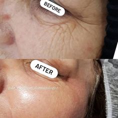 Best Procedures For Wrinkles, Halo Laser Before And After, Filler Under Eyes Before And After, Botox Under Eyes Before And After, Coolpeel Laser, Wrinkles Under Eyes, Smile Wrinkles, Face Laser, Chest Wrinkles