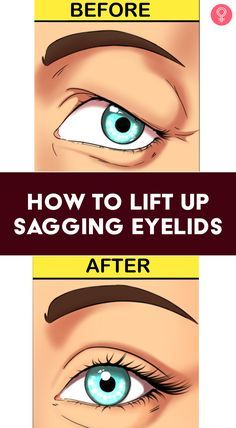 Sagging Eyes Remedies, Saggy Eyes Remedies, How To Fix Droopy Eyelids, Saggy Eyelids Remedies, Sagging Eyelids Natural Remedies, Makeup For Saggy Eyelids, Eye Lid Lift Droopy Eyelids, Tighten Eyelids, Swollen Eyelids Remedy