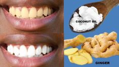 9 Surprising Ways To Whiter Teeth Turmeric Teeth Whitening, Braces Cost, Tartar Removal, Kids Teeth, Diy Teething