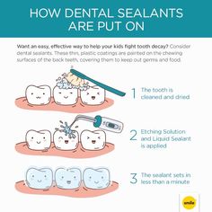 An easy, effective way to help your kids fight tooth decay, dental sealants are… Pediatric Dental Assistant, Dental Cartoon, Dental Education, Dental Assisting, Dental Decay, Dental Cavities