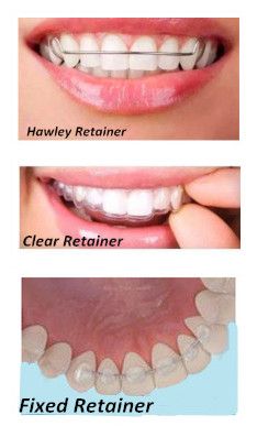 Metal Retainers For Teeth, Clear Retainers After Braces, Retainers For Teeth, Retainers After Braces, Braces Removal, Teeth After Braces, Braces Journey, Teeth Makeover