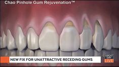 Gum Graft, Gum Surgery, Gum Recession, Loose Tooth, Teeth Health, Tooth Sensitivity, Gum Care