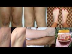 Lighten Dark Knees, Whiten Underarms Fast, Dark Knees, How To Whiten Underarms, Armpit Whitening, Dark Elbows, Underarm Whitening Cream, Powder Milk, Spot Remover