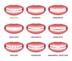 Straight Teeth With Braces, Teeth Types, Straighten Teeth Without Braces, Perfect Smile Teeth, Teeth Correction, Teeth Problems, Dental Animation, Braces Pain, Myofunctional Therapy