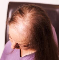 Menopause hair thinning & hair loss can occur due to a hormonal imbalance when women produce lower levels of oestrogen and progesterone. Prp Therapy, Hormonal Imbalance, Hair Thinning, Bring It Back, Hydrate Hair, Stimulate Hair Growth