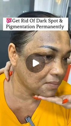 Pigmentation Remedy, Dark Spots On Face, Dark Spots On Skin, Skin Spots, Spots On Face, Remove Dark Spots, Dry Skin Care, Lighten Skin, Face Skin Care